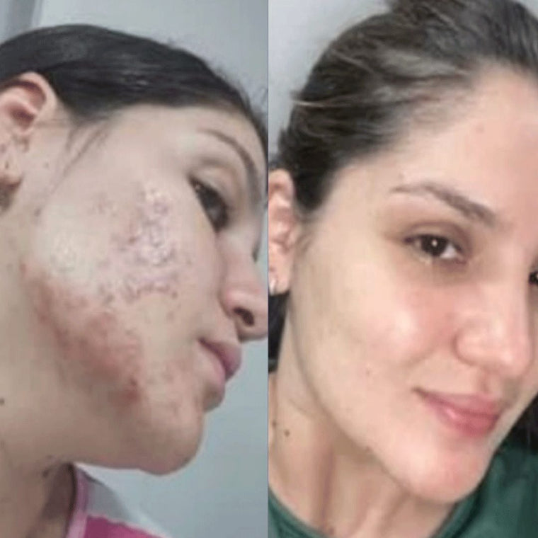 Antes y después real · comunidad Hanna's