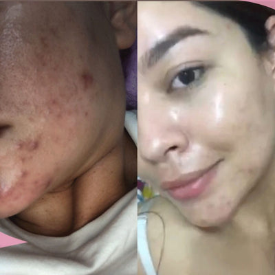 Antes y después real · comunidad Hanna's