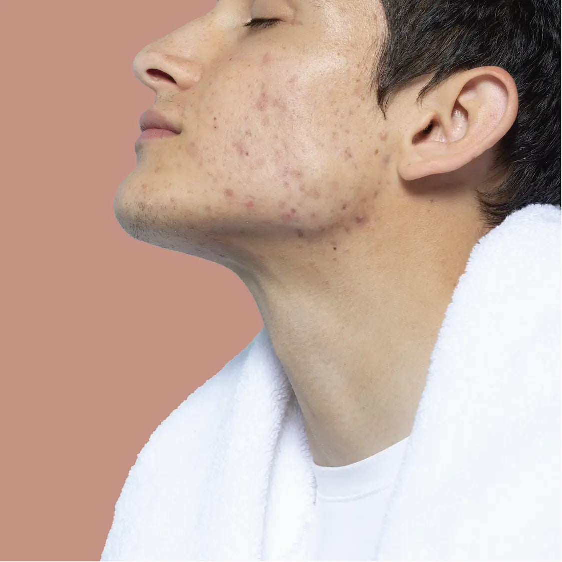 Acné hormonal