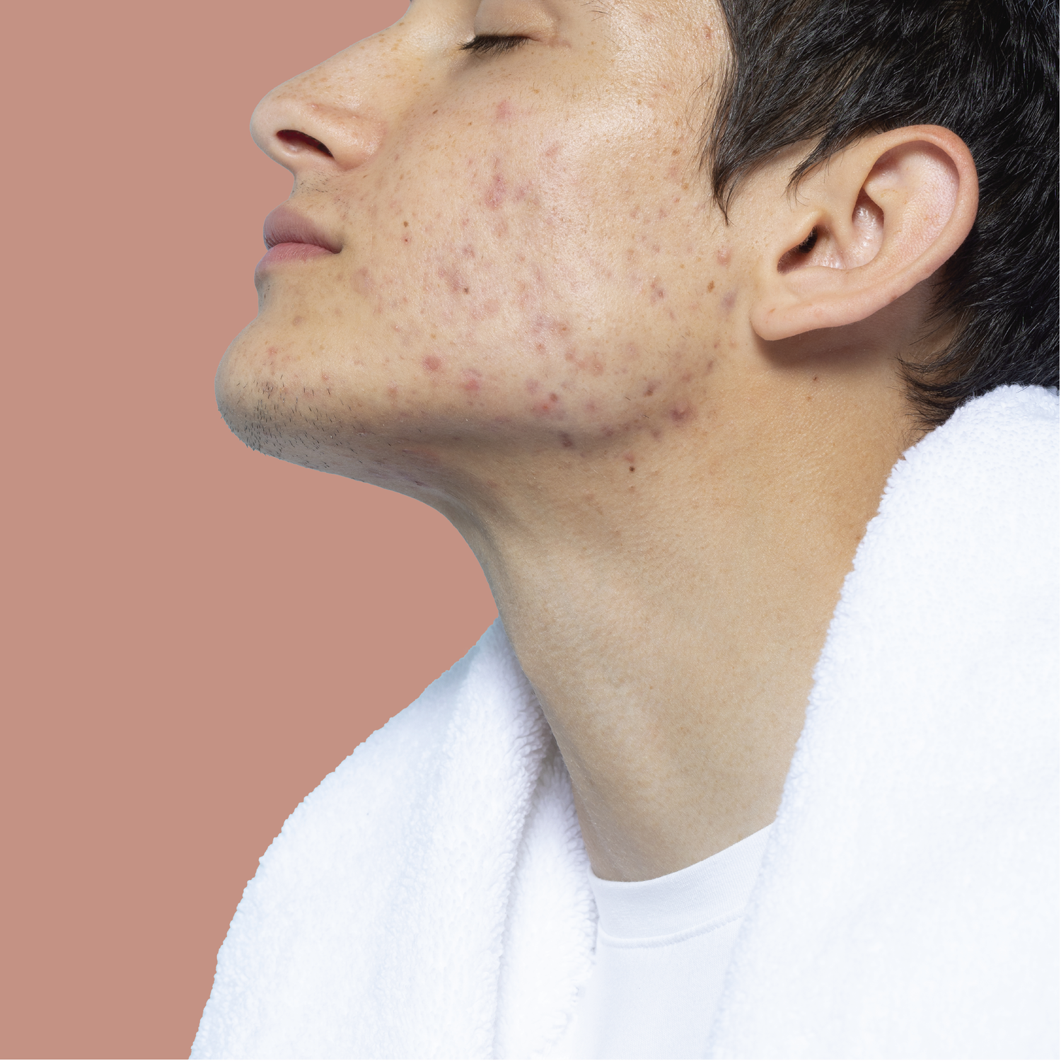 Acné hormonal