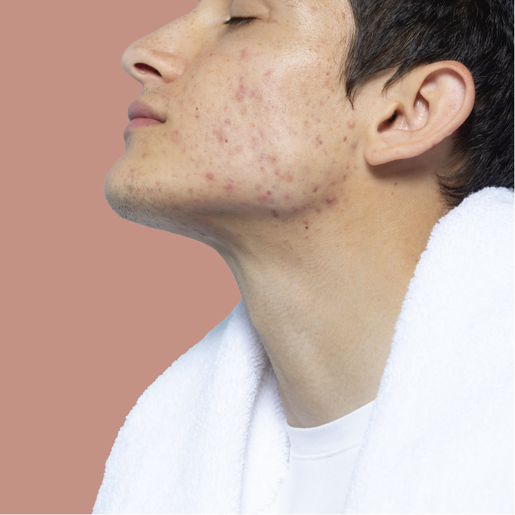Acné hormonal
