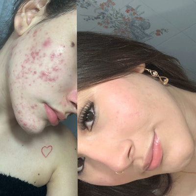 Antes y después real · comunidad Hanna's
