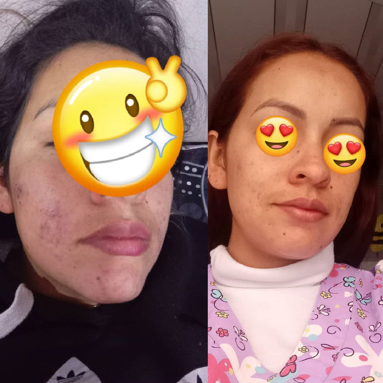 Antes y después real · comunidad Hanna's